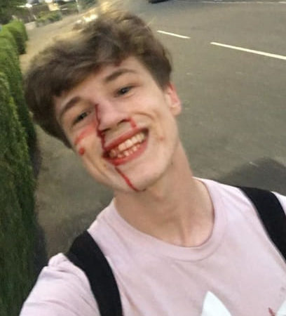 Garoto posta foto sorrindo mesmo após agressão pra mandar recado ao homofóbico