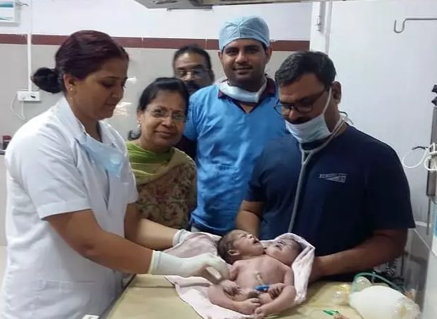 Bebê nasce com duas cabeças e três braços