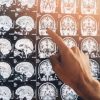 Delírio e psicose: cientistas alertam para distúrbios cerebrais em casos de covid-19