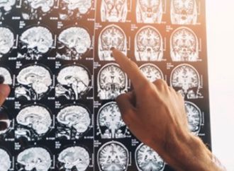 Delírio e psicose: cientistas alertam para distúrbios cerebrais em casos de covid-19