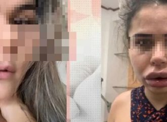 Dentista é acusada de deformar rosto de 40 mulheres após harmonização facial