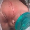 Bebê tem corte no rosto em cesárea de emergência