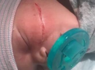 Bebê tem corte no rosto em cesárea de emergência
