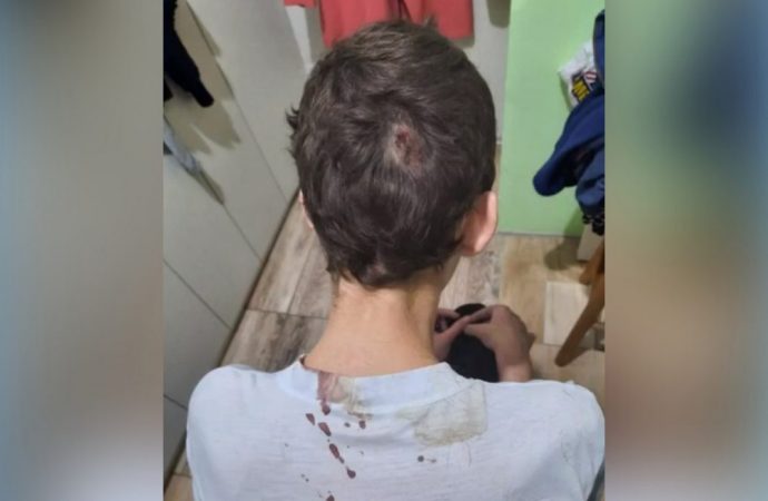 COM FOTOS: adolescente autista espancado pelo pai em Canoas tem diversas lesões pelo corpo