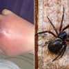 Mulher fica com mão de “luva de boxe” após ser picada por aranha