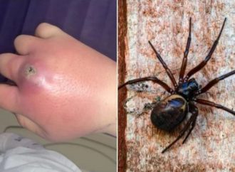 Mulher fica com mão de “luva de boxe” após ser picada por aranha