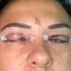 VÍDEO: Mulher sofre queimadura de 2º grau nos olhos e quase perde a visão após fazer extensão de cílios
