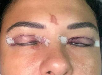 VÍDEO: Mulher sofre queimadura de 2º grau nos olhos e quase perde a visão após fazer extensão de cílios