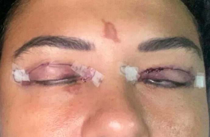 VÍDEO: Mulher sofre queimadura de 2º grau nos olhos e quase perde a visão após fazer extensão de cílios