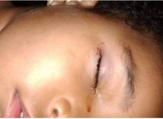Menina de três anos tem olho mordido por rato enquanto dormia