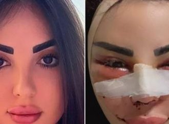 Modelo brasileira mostra lesões no rosto e denuncia violência cirúrgica na Turquia; imagens são fortes