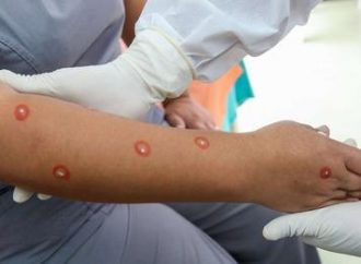 Brasil teve o maior aumento de casos de varíola dos macacos, diz OMS