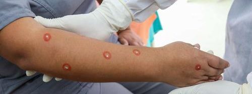 Brasil teve o maior aumento de casos de varíola dos macacos, diz OMS