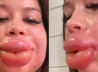 Lábios de jovem dobram de tamanho após preenchimento dar errado