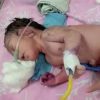 Nascimento de bebê-sereia surpreende e atrai multidão a maternidade