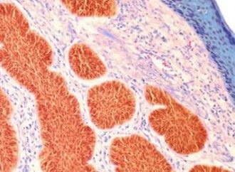 Cientistas acham caminho para tratar tipo mais letal de câncer de pele