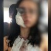 Jovem denuncia ter tido parte da bochecha arrancada após mordido do Ex-namorado