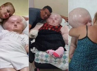 Brasileira com hidrocefalia completa 29 anos de idade.